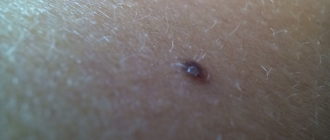 Черный шарик под кожей