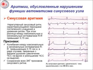 Нарушение сердечного ритма неуточненное(149,9) Дисфункция синусового узла, синусовая брадиаритмия ва