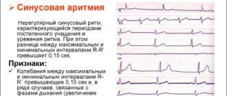 Нарушение сердечного ритма неуточненное(149,9) Дисфункция синусового узла, синусовая брадиаритмия ва