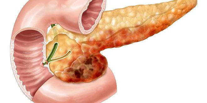 Воспаление поджелудочной от гармонов