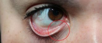 Дырочка около глаза