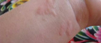 Волдырь после сладкого