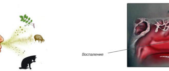 Крапивница и отёк слизистой носа