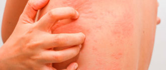 Началась аллергия