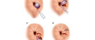 Нарост около анального отверстия у грудничка