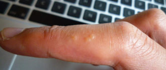 Водянистые прыщи, на руках и ногах