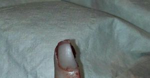 Дочка порезала палец и рассекла ноготь