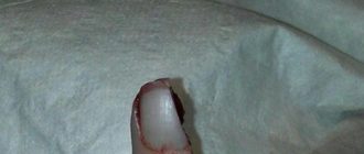 Дочка порезала палец и рассекла ноготь