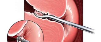Можно ли вылечить гиперплазию без выскабливания?