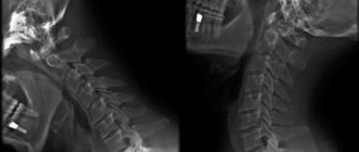 Дегенеративно-дистрофические изменения шейного отдела позвоночника с нарушение статики