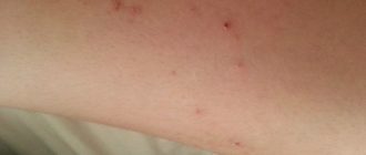 Чешется все тело до крови