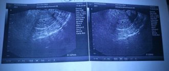 УЗИ на 15 дне задержки