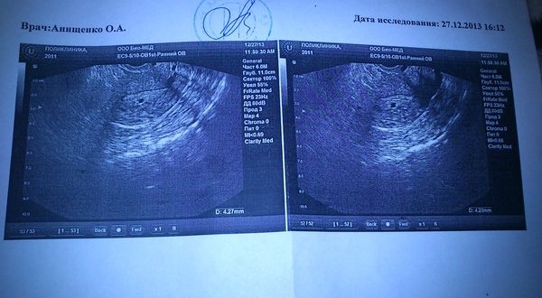 УЗИ на 15 дне задержки