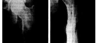 Дополнительная тень костной плотности