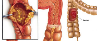 Возможно колит?