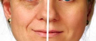Морины под глазами от одной процедуры микротоков для лица (