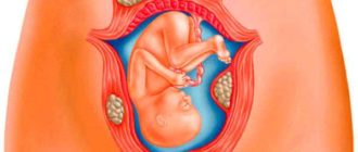 Миома при беременности