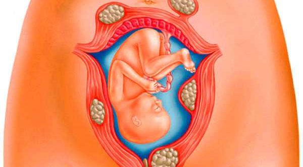 Миома при беременности