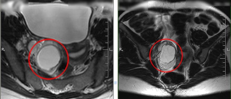 МРТ дермоидной кисты