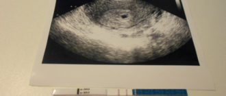 УЗИ через неделю после зачатия