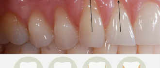 Десна отходят от зубов