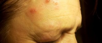 Воденистые пузырики на лбу