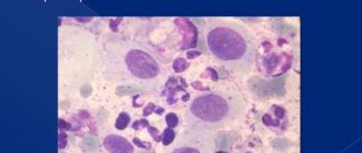 Воспаление с реактивными изменениями эпителия