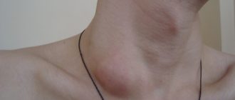 Надключичные лимфаденит справа