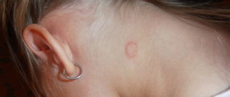 Что за пятно за ухом