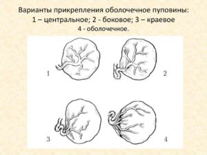 Краевое прекрепление пупочного канатика?