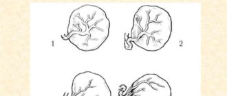 Краевое прекрепление пупочного канатика?