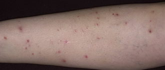 Чесотка или укусы блох