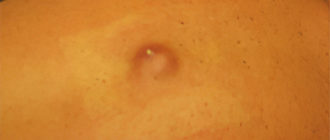 Воспаление атеромы молочной железы