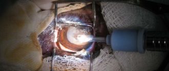 Выделения после выскабливания