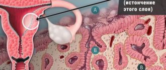 Возможно ли зачатие при тонком эндометрии