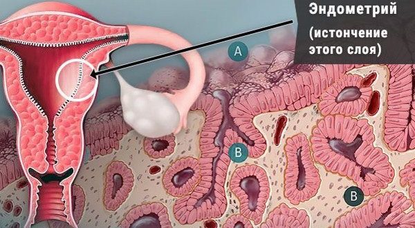 Возможно ли зачатие при тонком эндометрии