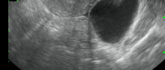 УЗИ, нашли кисту под вопросом