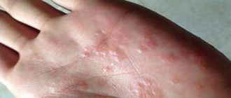 Мокнущая экзема