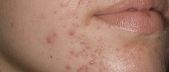 Дексаметазон и высыпания на лице