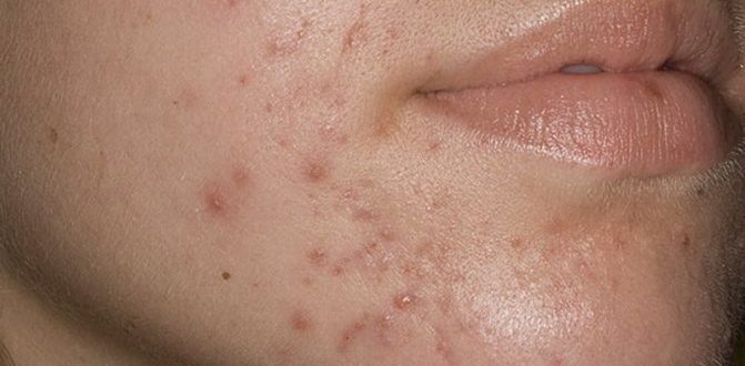 Дексаметазон и высыпания на лице