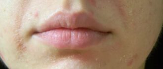 Мелкие прыщи в области подбородка и вокруг губ