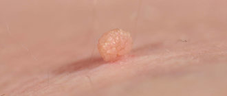 Нарост на коже ребенка