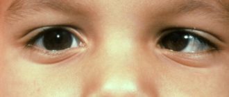 Дочь косит вбок оба глаза