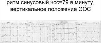 ЭКГ описание, синусовый ритм, вертикальное положение ЭОС