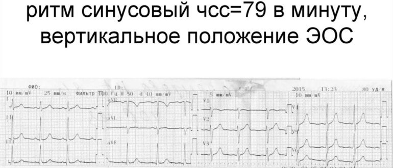 Экг вертикальная. Заключение ЭКГ синусовый ритм. Вертикальное ЭОС. Заключение ЭКГ ЭОС. ЭКГ при вертикальном положении ЭОС. Синусовый ритм 70.