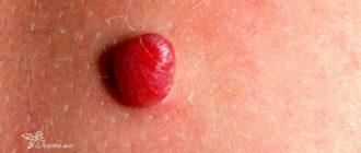 Может ли рассосаться пиогенная гранулёма