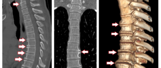 Деформирующий остеохондроз