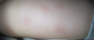 На попе у ребёнка сухие пятнышки