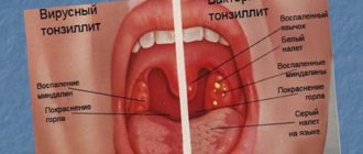 На гланде опухоль