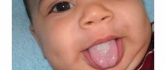 Молочница у девочки 3 годика